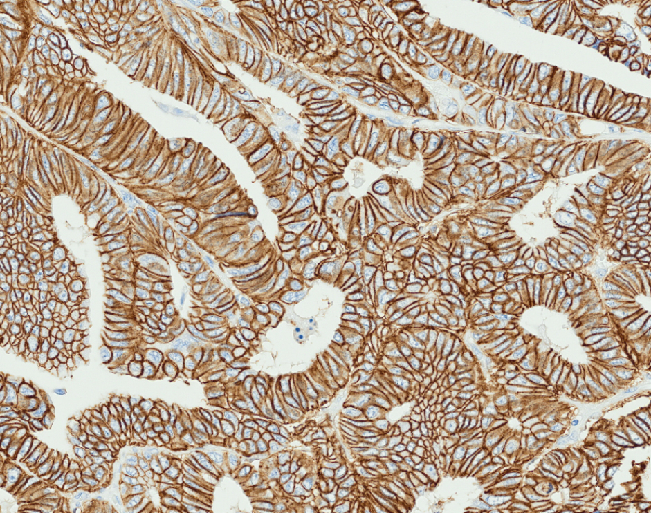 Strong membranous staining for CDH17 observed in neoplastic cells of colorectal carcinoma.