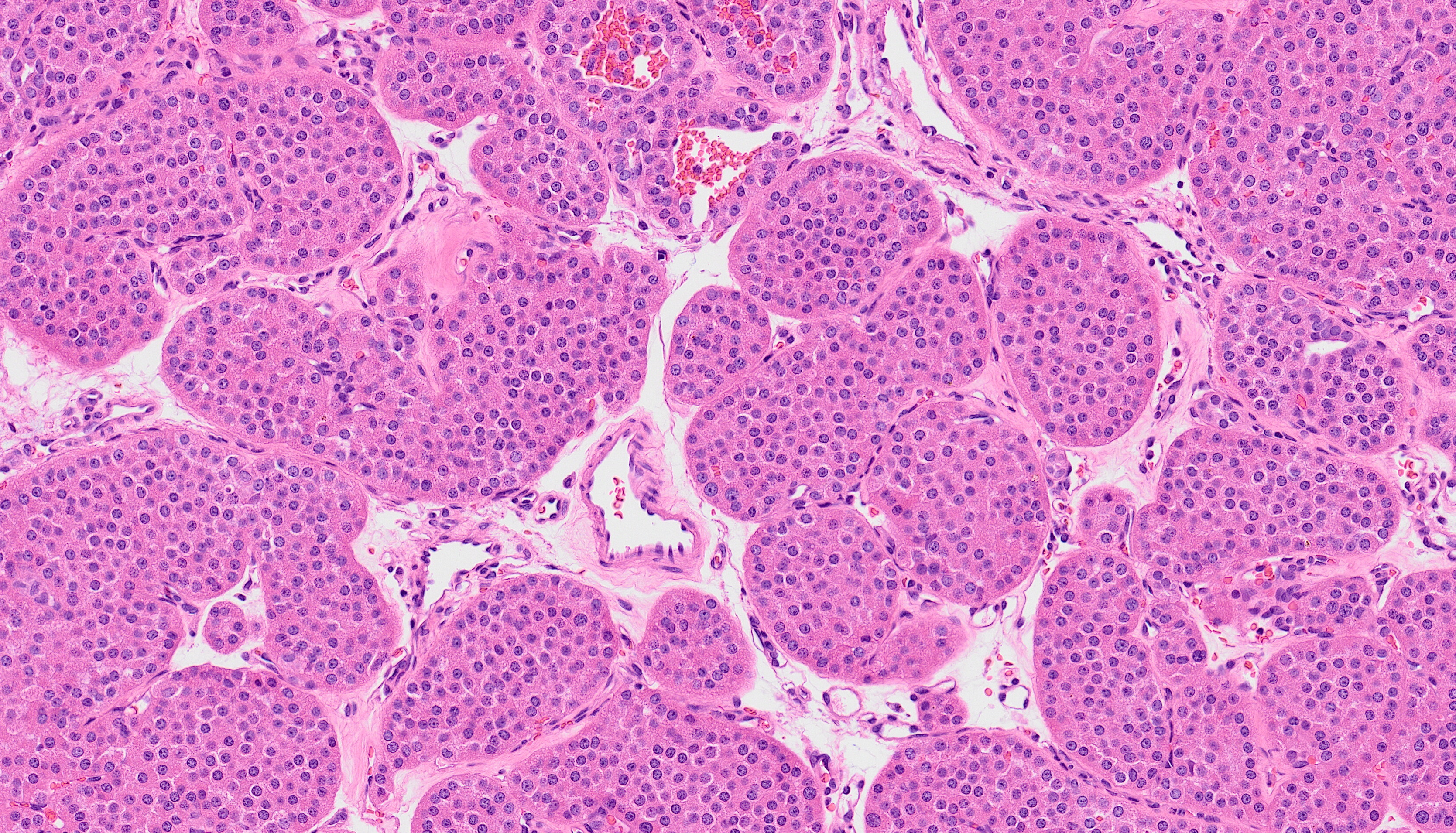 In this classic renal oncocytoma, one can appreciate the well-stained nests and islands of oncocytes set in edematous and vascular stroma.
